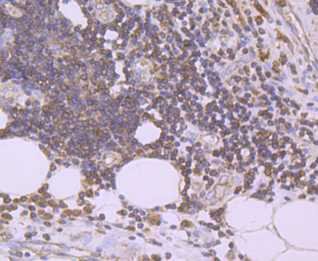 Fig3:; Immunohistochemical analysis of paraffin-embedded human colon carcinoma tissue using anti-Urokinase antibody. The section was pre-treated using heat mediated antigen retrieval with Tris-EDTA buffer (pH 8.0-8.4) for 20 minutes.The tissues were blocked in 5% BSA for 30 minutes at room temperature, washed with ddH; 2; O and PBS, and then probed with the primary antibody ( 1/50) for 30 minutes at room temperature. The detection was performed using an HRP conjugated compact polymer system. DAB was used as the chromogen. Tissues were counterstained with hematoxylin and mounted with DPX.