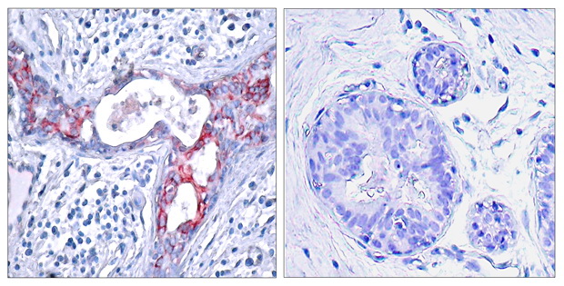 Immunohistochemical analysis of paraffin-embedded human breast carcinoma tissue using GSK3u03b2 (Phospho-Ser9) Antibody  (left) or the same antibody preincubated with blocking peptide #51002 (right).