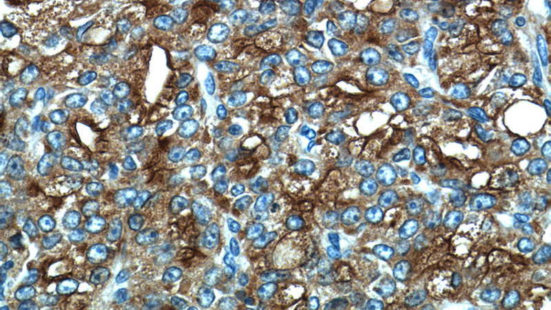 Immunohistochemistry of paraffin-embedded human prostate cancer tissue slide using Catalog No:107739(ACPP Antibody) at dilution of 1:50 (under 40x lens)