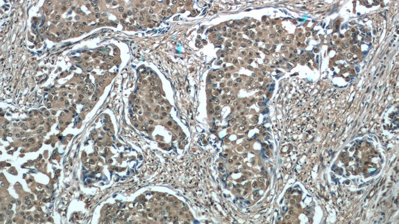 Immunohistochemistry of paraffin-embedded human breast cancer tissue slide using Catalog No:114536(RAN Antibody) at dilution of 1:50 (under 10x lens)