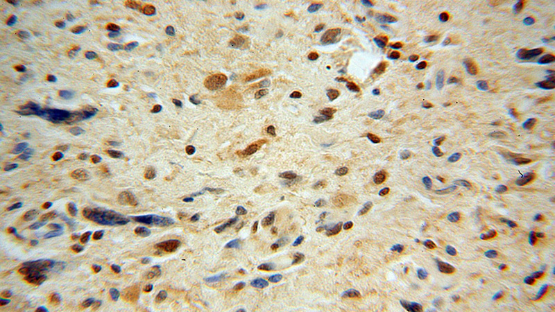 Immunohistochemical of paraffin-embedded human gliomas using Catalog No:109603(CSNK2A1 antibody) at dilution of 1:100 (under 40x lens)