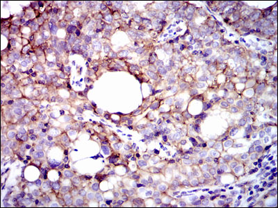 Immunohistochemical analysis of paraffin-embedded cervical cancer tissues using ITGB1 mouse mAb with DAB staining.