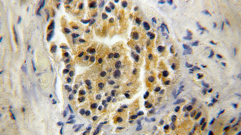 Immunohistochemical of paraffin-embedded human prostate cancer using Catalog No:111174(GSNOR,ADH5 antibody) at dilution of 1:50 (under 40x lens)