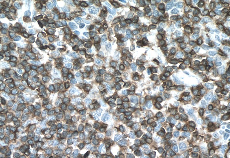 Immunohistochemistry of paraffin-embedded human tonsillitis tissue slide using Catalog No:109020(CD3E Antibody) at dilution of 1:200 (under 40x lens). Heat mediated antigen retrieved with Tris-EDTA buffer, pH9.0
