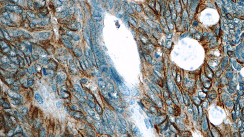 Immunohistochemistry of paraffin-embedded human colon cancer tissue slide using Catalog No:109340(CLDN23 Antibody) at dilution of 1:50 (under 40x lens)
