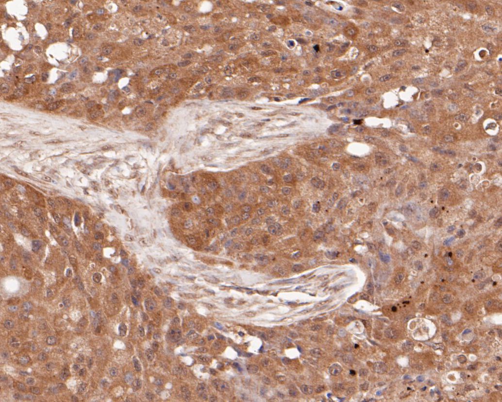 Fig7: Immunohistochemical analysis of paraffin-embedded human breast carcinoma tissue using anti-SPATA5L1 antibody. The section was pre-treated using heat mediated antigen retrieval with Tris-EDTA buffer (pH 8.0-8.4) for 20 minutes.The tissues were blocke