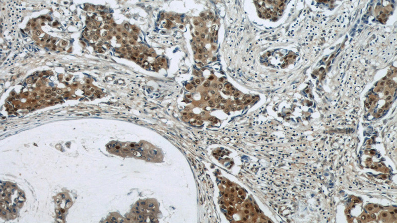 Immunohistochemical of paraffin-embedded human breast cancer using Catalog No:109593(CSE1L antibody) at dilution of 1:50 (under 10x lens)