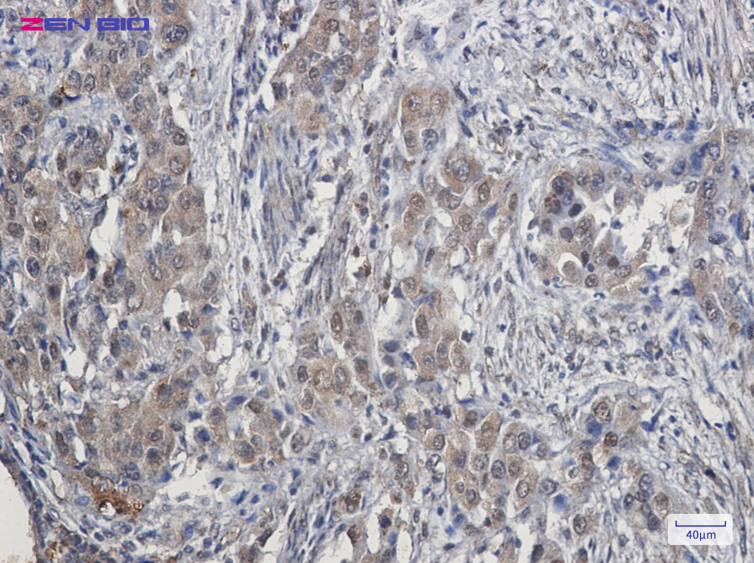 Immunohistochemistry of Cdk4 in paraffin-embedded Human lung cancer tissue using Cdk4 Rabbit pAb at dilution 1/50