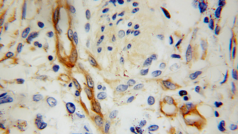 Immunohistochemical of paraffin-embedded human colon cancer using Catalog No:112941(MYL12B antibody) at dilution of 1:100 (under 40x lens)