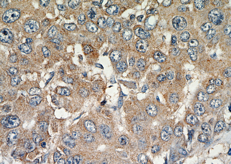 Immunohistochemical of paraffin-embedded human liver cancer using Catalog No:112388(MAGEC3 antibody) at dilution of 1:50 (under 40x lens)