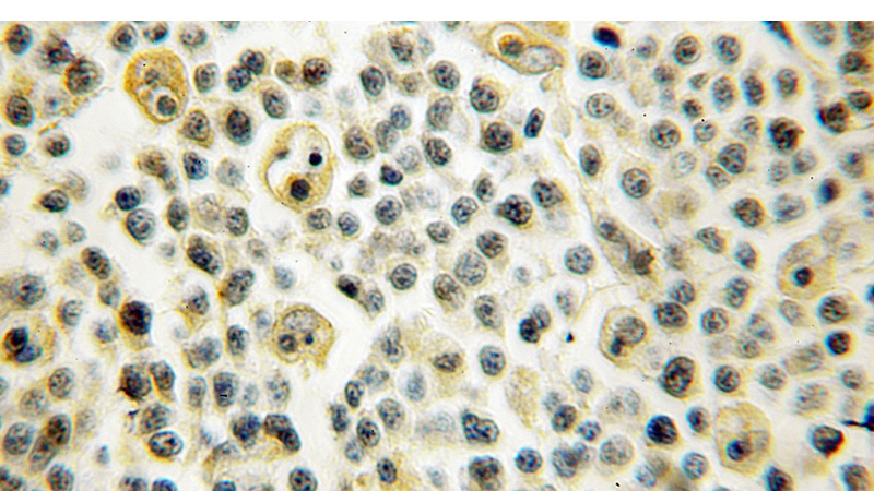 Immunohistochemical of paraffin-embedded human lymphoma using Catalog No:111867(ITGB7 antibody) at dilution of 1:50 (under 10x lens)