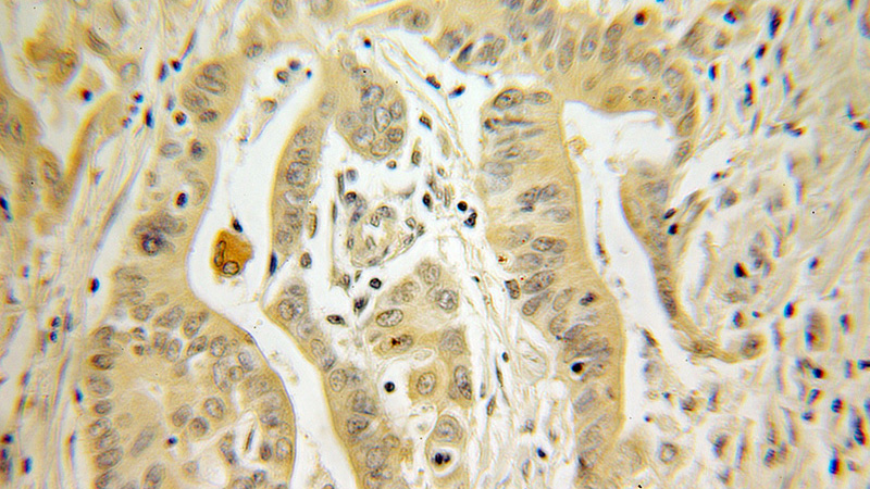 Immunohistochemical of paraffin-embedded human colon cancer using Catalog No:111093(GM2A antibody) at dilution of 1:100 (under 10x lens)