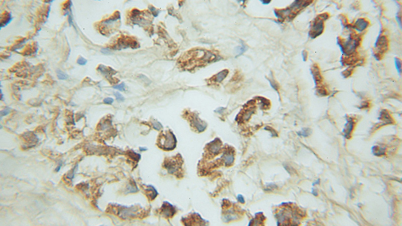 Immunohistochemical of paraffin-embedded human prostate cancer using Catalog No:116078(TM7SF2 antibody) at dilution of 1:50 (under 10x lens)