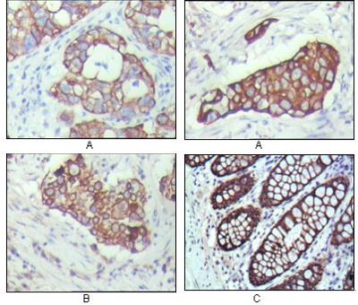 Immunohistochemical analysis of paraffin-embedded human breast carcinoma(A), lung cancer(B) and normal colon tissue(C), showing cytoplasmic localization with DAB staining using KRT19 mouse mAb.