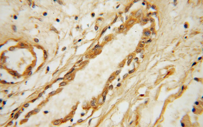 Immunohistochemical of paraffin-embedded human prostate cancer using Catalog No:114281(PRSS8 antibody) at dilution of 1:50 (under 40x lens)