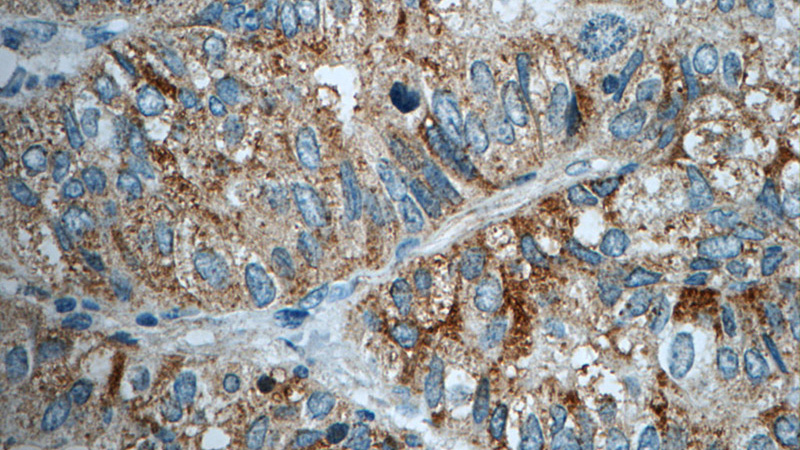 Immunohistochemistry of paraffin-embedded human breast cancer tissue slide using Catalog No:108069(ANKRD13D Antibody) at dilution of 1:50 (under 40x lens)
