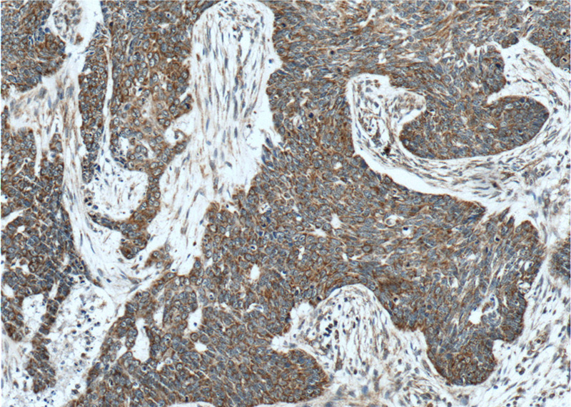 Immunohistochemistry of paraffin-embedded human skin cancer tissue slide using Catalog No:111606(IDH3G Antibody) at dilution of 1:50 (under 10x lens)