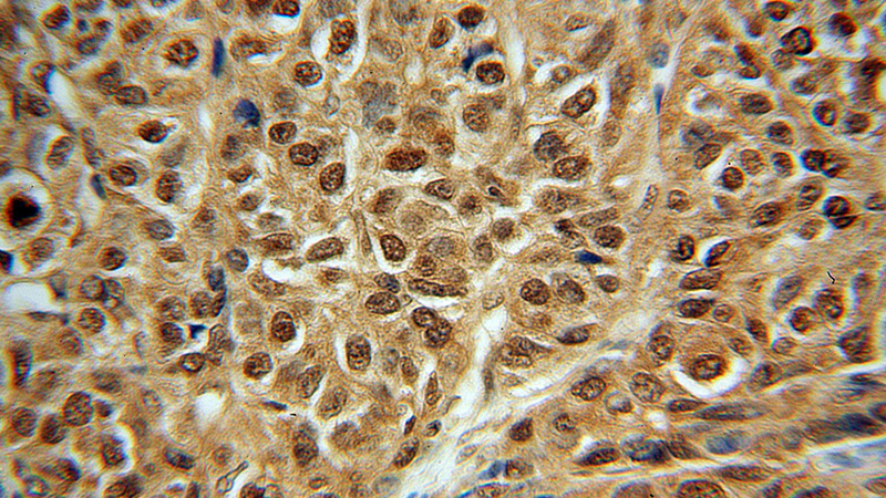 Immunohistochemical of paraffin-embedded human liver cancer using Catalog No:113770(PFKFB3 antibody) at dilution of 1:100 (under 40x lens)