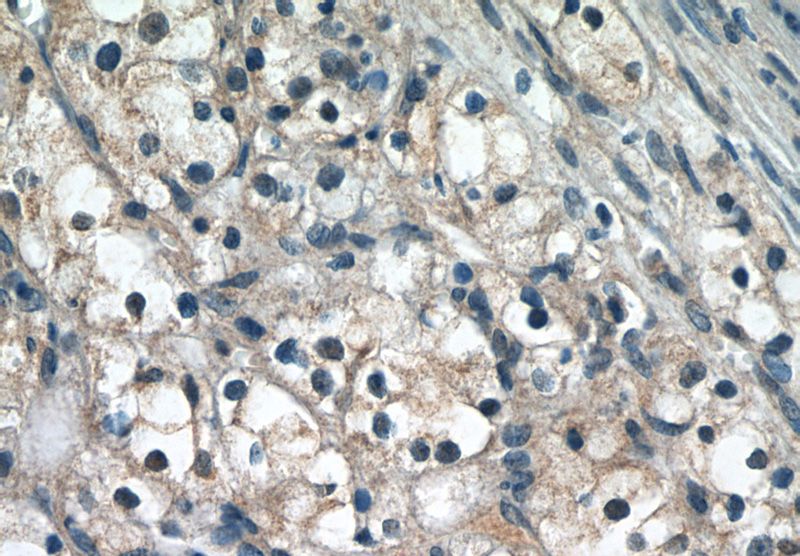 Immunohistochemistry of paraffin-embedded human renal cell carcinoma tissue slide using Catalog No:113907(PIN1 Antibody) at dilution of 1:50 (under 40x lens)