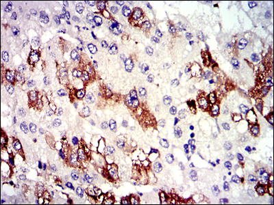 Fig5: Immunohistochemical analysis of paraffin-embedded liver cancer tissues using anti-TUBA8 antibody. Counter stained with hematoxylin.