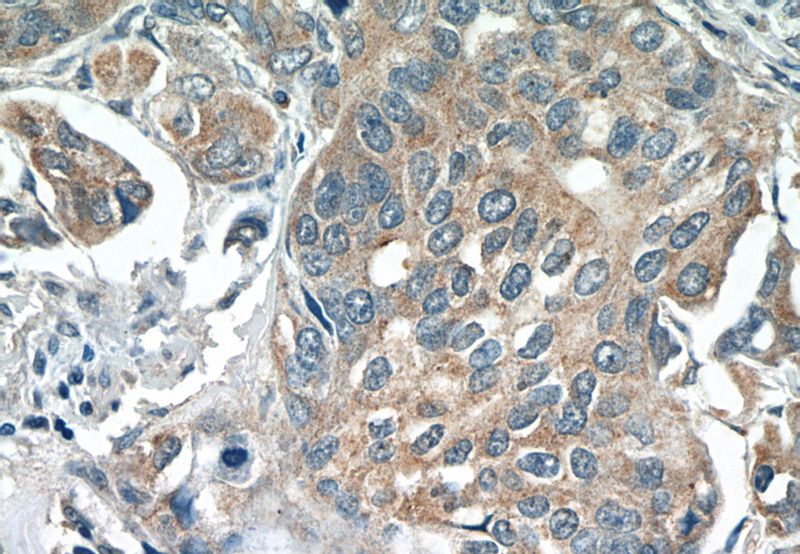Immunohistochemistry of paraffin-embedded human cervical cancer tissue slide using Catalog No:114107(PPP2R5E Antibody) at dilution of 1:50 (under 40x lens)