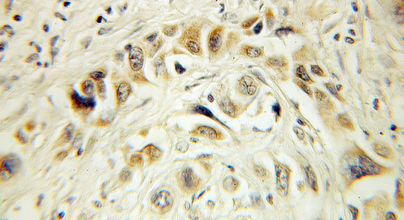 Immunohistochemical of paraffin-embedded human lung cancer using Catalog No:111298(HERPUD1 antibody) at dilution of 1:100 (under 10x lens)