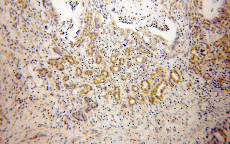 Immunohistochemical of paraffin-embedded human pancreas cancer using Catalog No:110095(DNAJB4 antibody) at dilution of 1:100 (under 10x lens)
