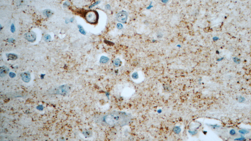 Immunohistochemistry of paraffin-embedded human brain tissue slide using Catalog No:111889(JMY Antibody) at dilution of 1:50 (under 40x lens)
