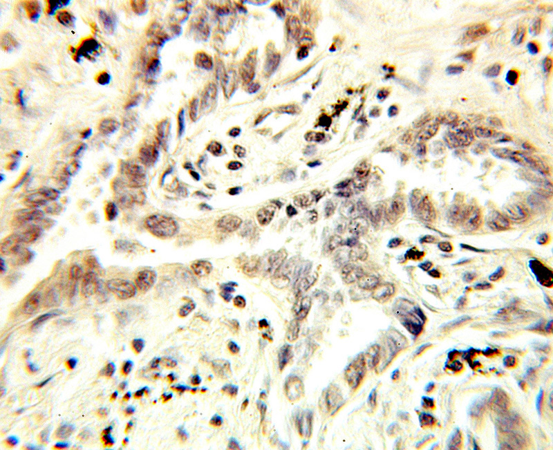 Immunohistochemical of paraffin-embedded human lung cancer using Catalog No:113034(CBP80 antibody) at dilution of 1:100 (under 10x lens)
