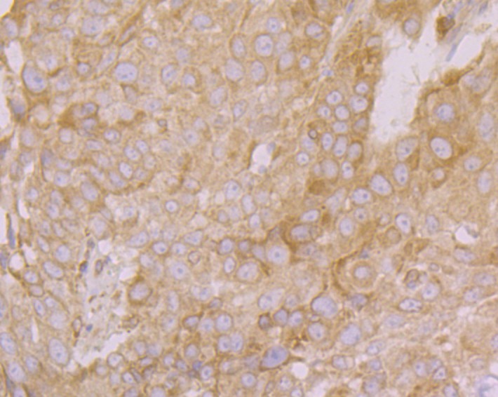 Fig6: Immunohistochemical analysis of paraffin-embedded human lung cancer tissue using anti-PHF8 antibody. Counter stained with hematoxylin.