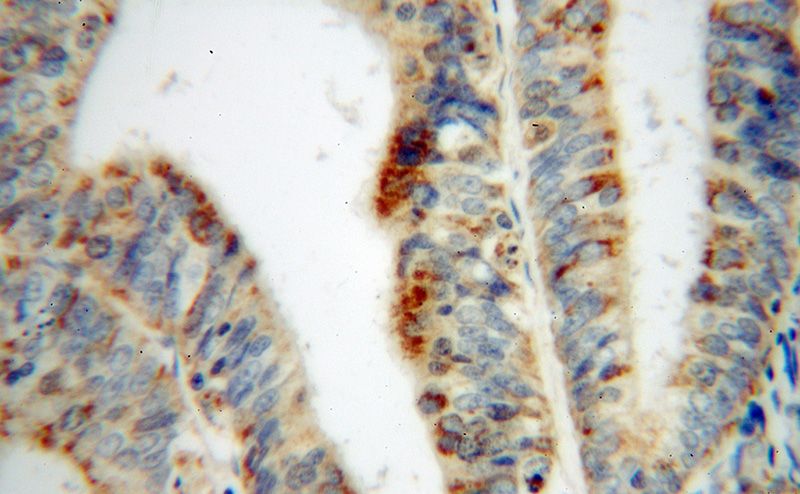 Immunohistochemical of paraffin-embedded human endometrial cancer using Catalog No:116115(TYMS antibody) at dilution of 1:100 (under 40x lens)