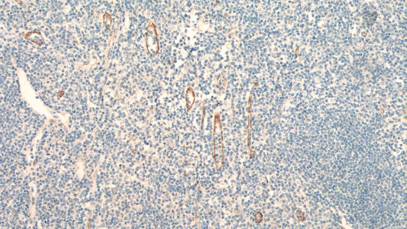 Immunohistochemistry of paraffin-embedded human tonsillitis tissue slide using Catalog No:107131(CD31 Antibody) at dilution of 1:400 (under 10x lens). Heat mediated antigen retrieved with Tris-EDTA buffer, pH9.0