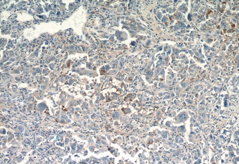 Immunohistochemistry of paraffin-embedded human liver cancer tissue slide using Catalog No:109521(CPPED1 Antibody) at dilution of 1:50 (under 10x lens)