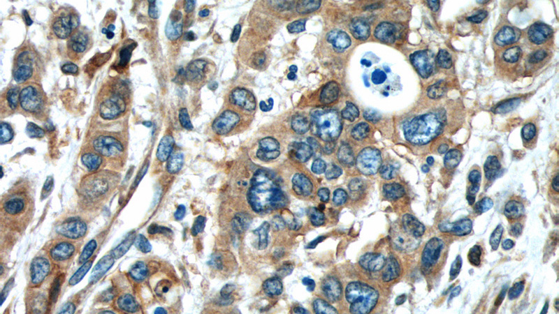 Immunohistochemistry of paraffin-embedded human stomach cancer tissue slide using Catalog No:107770(ADAMTS12 Antibody) at dilution of 1:50 (under 40x lens)