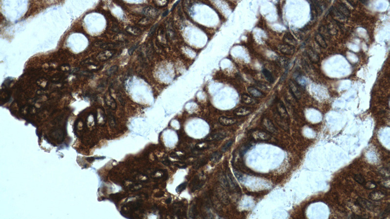 Immunohistochemistry of paraffin-embedded human colon tissue slide using Catalog No:107479(PPARG Antibody) at dilution of 1:50 (under 40x lens)