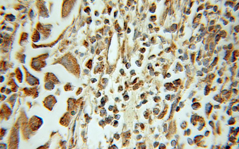 Immunohistochemical of paraffin-embedded human prostate cancer using Catalog No:111487(HMGN2 antibody) at dilution of 1:50 (under 10x lens)