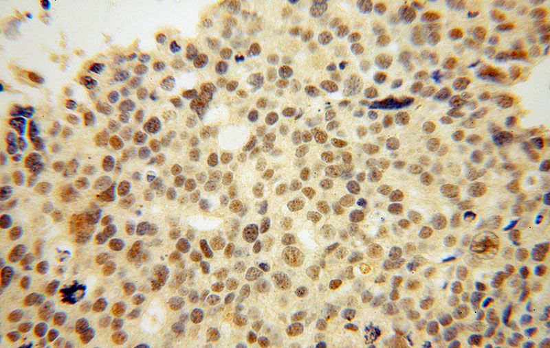 Immunohistochemical of paraffin-embedded human ovary tumor using Catalog No:116049(THoc6 antibody) at dilution of 1:50 (under 40x lens)