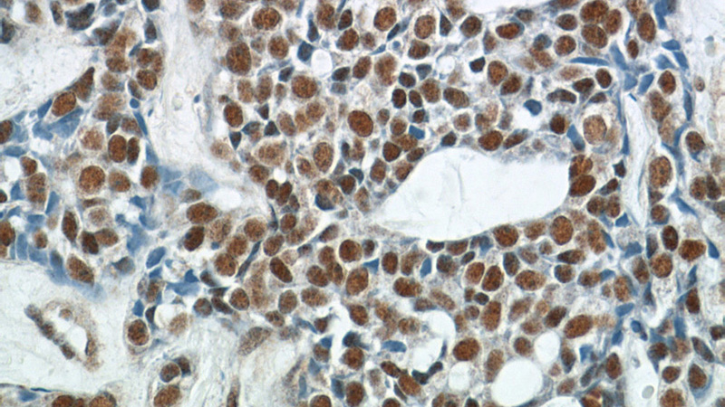 Immunohistochemistry of paraffin-embedded human cervical cancer tissue slide using Catalog No:114042(POLR2F Antibody) at dilution of 1:200 (under 40x lens)