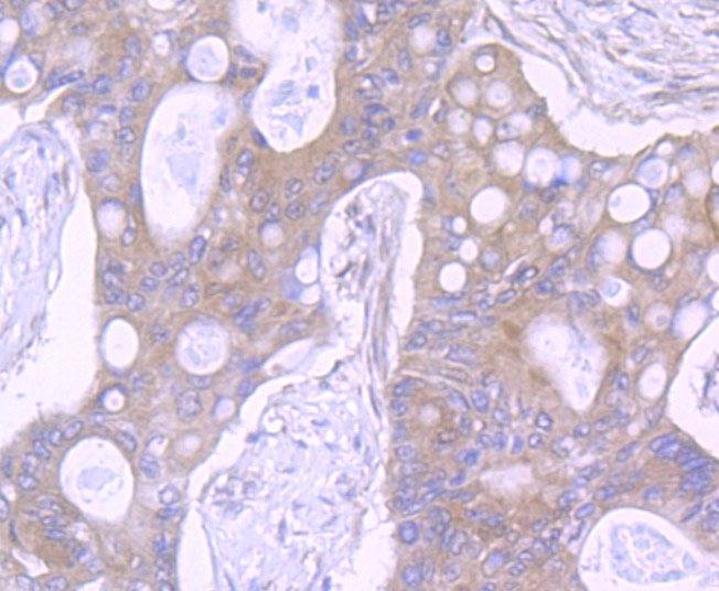 Fig4: Immunohistochemical analysis of paraffin-embedded human colon cancer tissue using anti-NLRC3 antibody. Counter stained with hematoxylin.