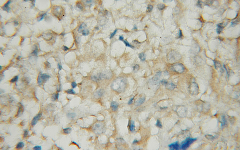 Immunohistochemical of paraffin-embedded human gliomas using Catalog No:113657(PDE1A antibody) at dilution of 1:50 (under 10x lens)