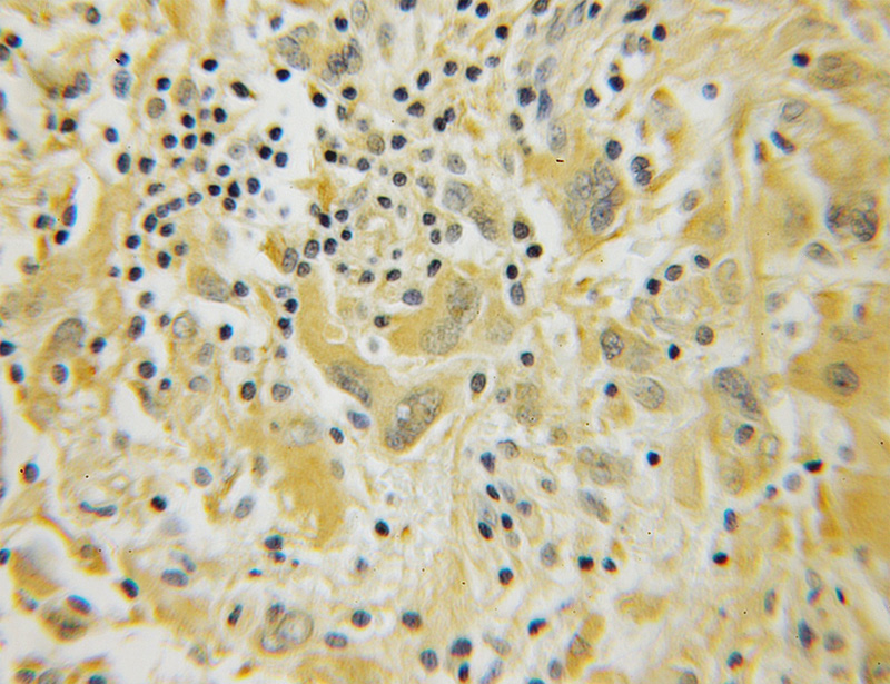 Immunohistochemical of paraffin-embedded human gliomas using Catalog No:109944(DIRAS1 antibody) at dilution of 1:100 (under 10x lens)