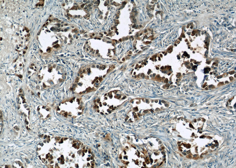 Immunohistochemical of paraffin-embedded human lung cancer using Catalog No:114967(S100P antibody) at dilution of 1:50 (under 10x lens)