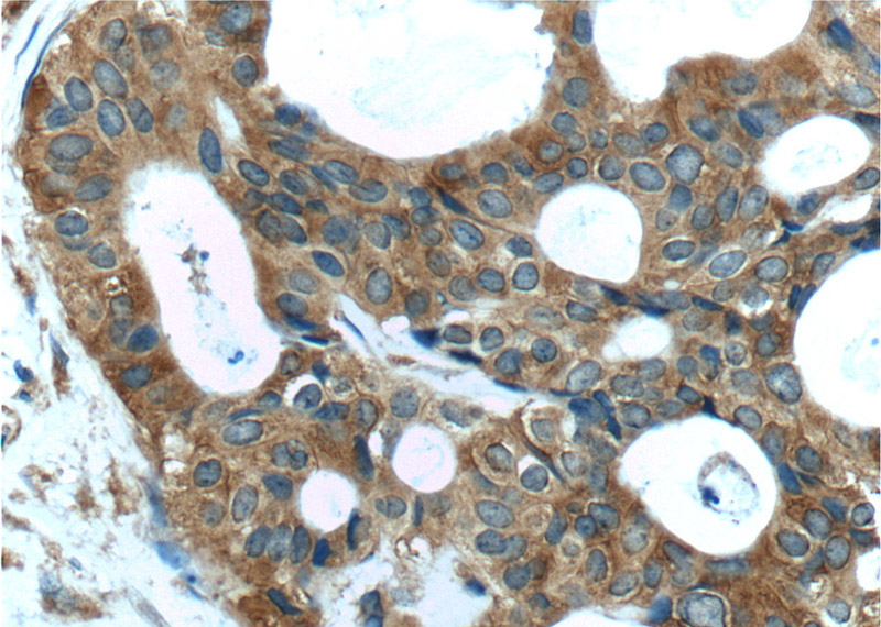 Immunohistochemistry of paraffin-embedded human breast cancer tissue slide using Catalog No:115862(TBC1D17 Antibody) at dilution of 1:50 (under 40x lens)