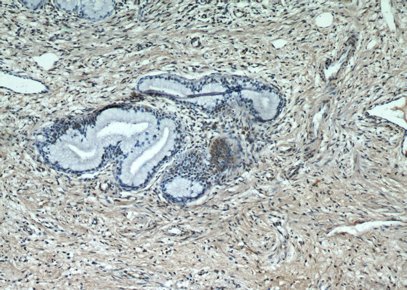 Immunohistochemical of paraffin-embedded human cervix using Catalog No:110475(ESR2 Beta-3 antibody) at dilution of 1:50 (under 10x lens)