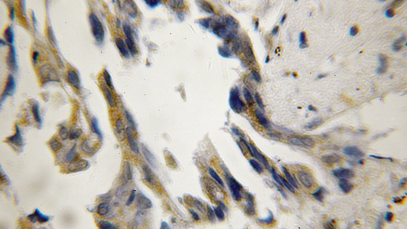 Immunohistochemical of paraffin-embedded human lung cancer using Catalog No:116121(DNAJA3 antibody) at dilution of 1:50 (under 40x lens)