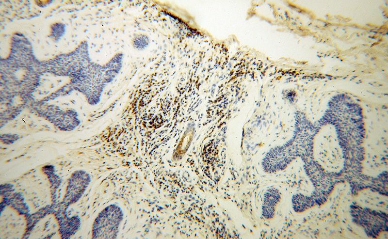 Immunohistochemical of paraffin-embedded human skin cancer using Catalog No:111015(GK3P antibody) at dilution of 1:100 (under 10x lens)