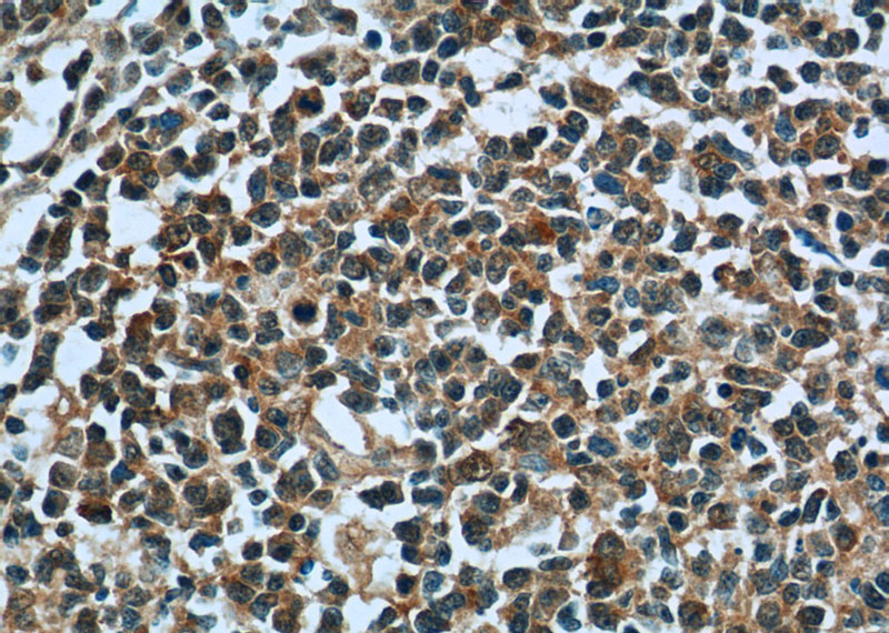 Immunohistochemistry of paraffin-embedded human tonsillitis tissue slide using Catalog No:116383(TTC37 Antibody) at dilution of 1:50 (under 40x lens)