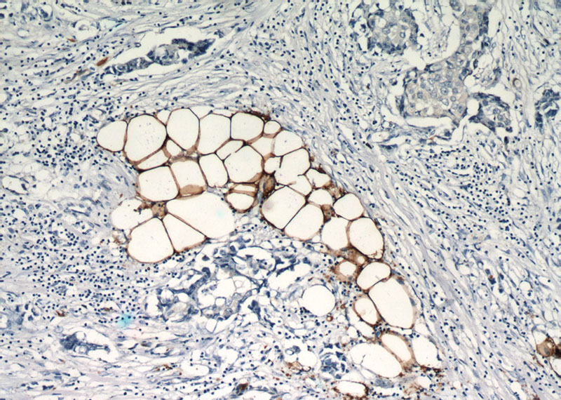 Immunohistochemical of paraffin-embedded human breast cancer using Catalog No:110440(FABP4 antibody) at dilution of 1:50 (under 10x lens)