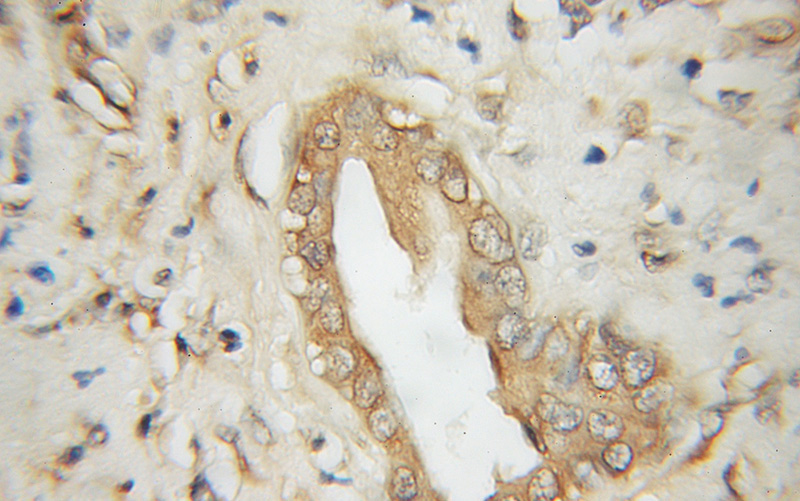 Immunohistochemical of paraffin-embedded human pancreas cancer using Catalog No:115739(STT3A antibody) at dilution of 1:50 (under 10x lens)
