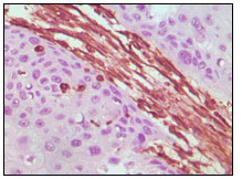 Immunohistochemical analysis of paraffin-embedded human lung carcinoma tissue, showing cytoplasmic localization using Vimentin mouse mAb with DAB staining.
